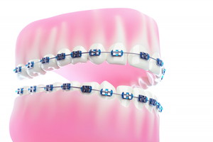 ブラケット矯正